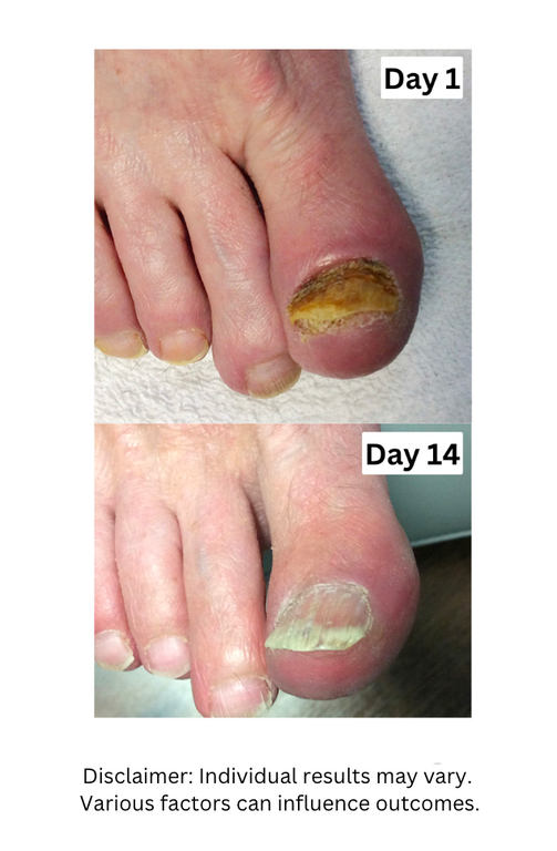 OEDO™ Herbal Nail Essence - Late Stage Fungus (4x)