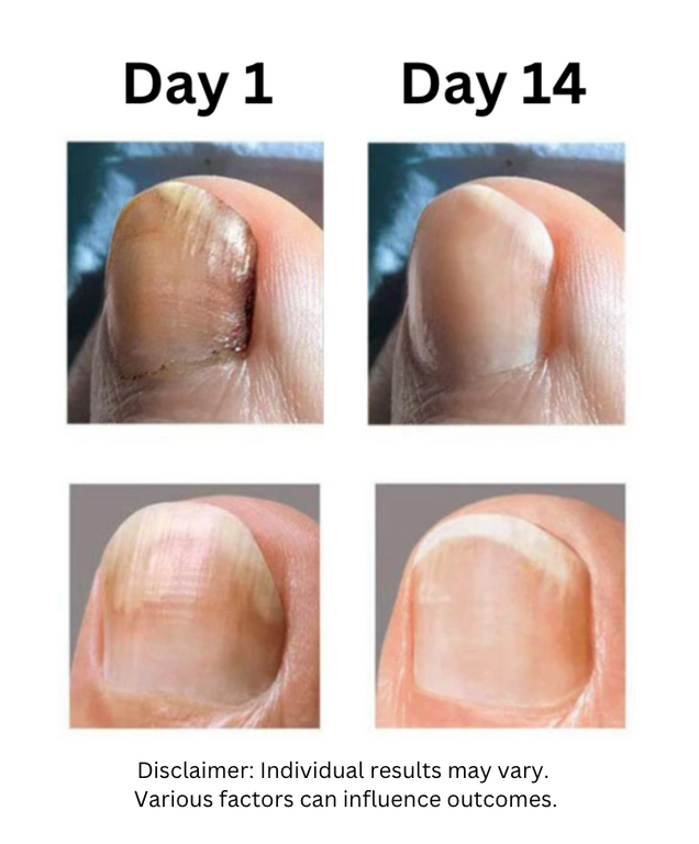 OEDO™ Herbal Nail Essence - Late Stage Fungus (4x)